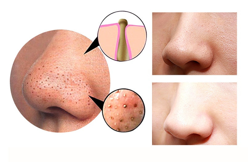 4 in 1 Body Guasha Cupping Blackhead Remover Machine